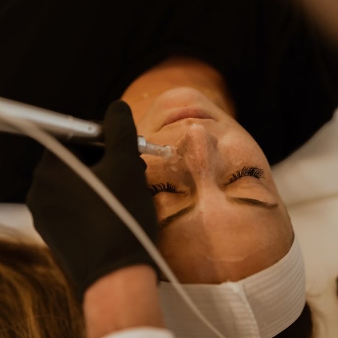 Microneedling